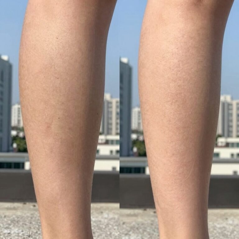 올리브영 제모크림 사용 후 붉게 자극받은 다리 피부와 정상 피부 비교