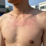 겨드랑이 땀띠로 인한 붉은 발진과 피부 자극을 보여주는 클로즈업 사진