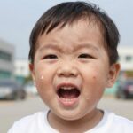 유아 구내염으로 입안에 생긴 하얀 궤양 모습