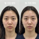 팔 기미 제거 레이저 시술 전후 피부 상태 확인